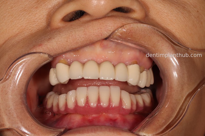 Case 3: Full mouth all-on-6 in a patient with severe periodontal disease