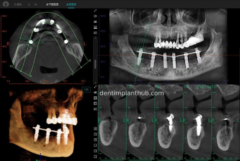 Case 3: Full mouth all-on-6 in a patient with severe periodontal disease