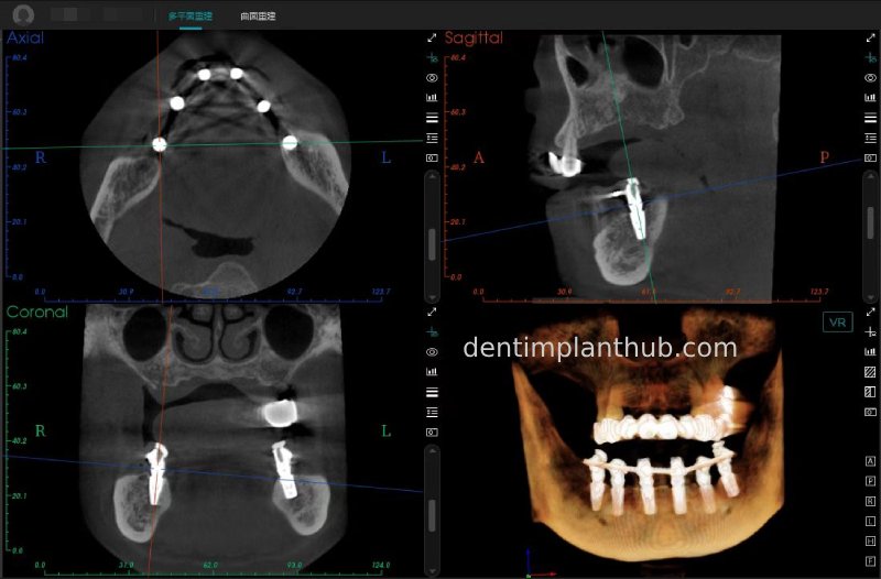 Case 3: Full mouth all-on-6 in a patient with severe periodontal disease