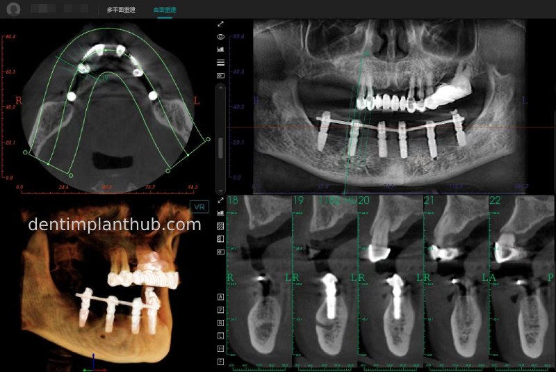 Case 3: Full mouth all-on-6 in a patient with severe periodontal disease