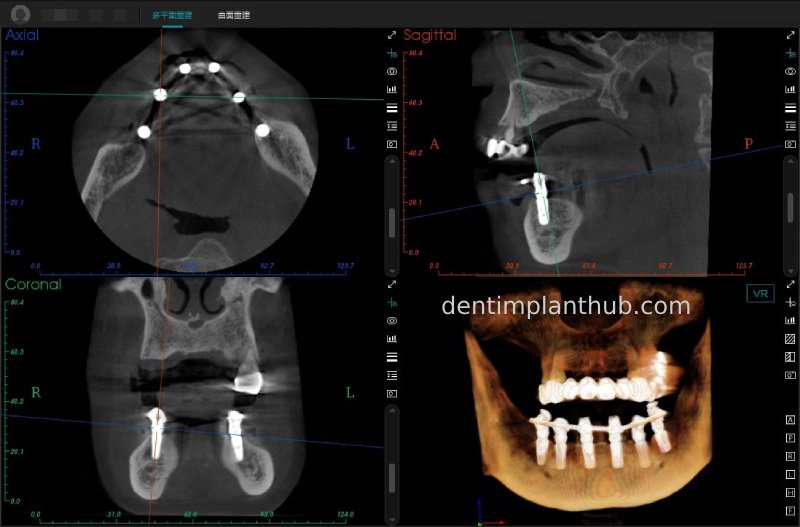Case 3: Full mouth all-on-6 in a patient with severe periodontal disease