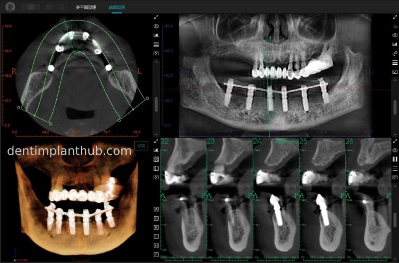Case 3: Full mouth all-on-6 in a patient with severe periodontal disease