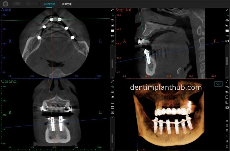 Case 3: Full mouth all-on-6 in a patient with severe periodontal disease