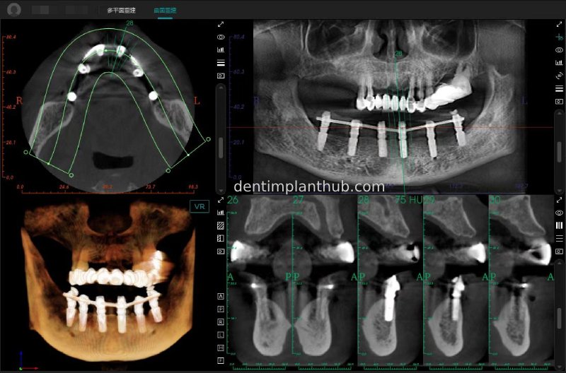 Case 3: Full mouth all-on-6 in a patient with severe periodontal disease