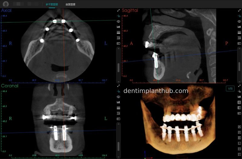 Case 3: Full mouth all-on-6 in a patient with severe periodontal disease