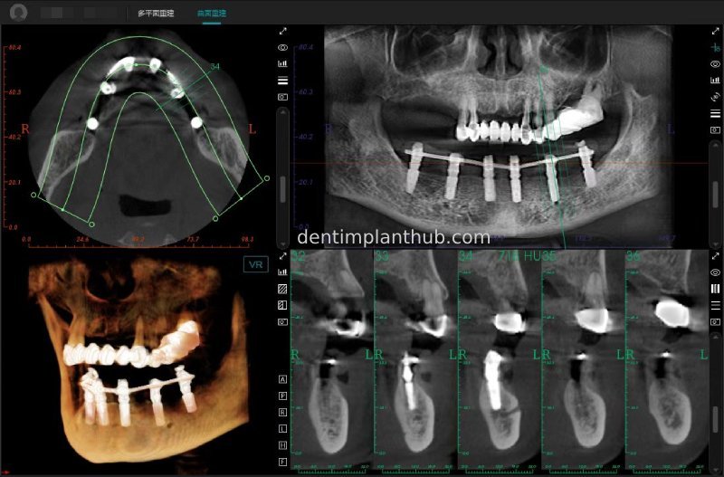 Case 3: Full mouth all-on-6 in a patient with severe periodontal disease