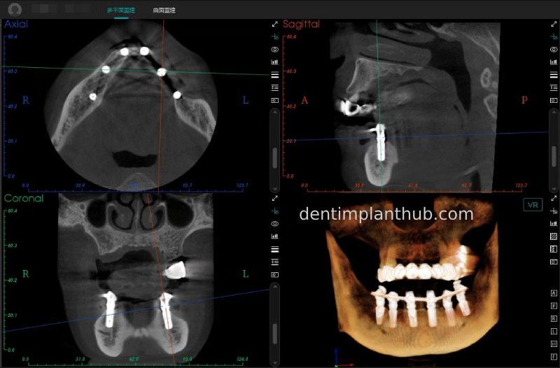 Case 3: Full mouth all-on-6 in a patient with severe periodontal disease