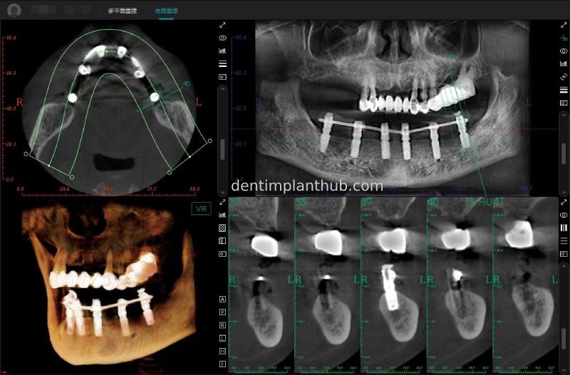 Case 3: Full mouth all-on-6 in a patient with severe periodontal disease
