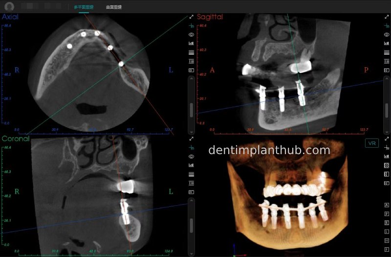 Case 3: Full mouth all-on-6 in a patient with severe periodontal disease