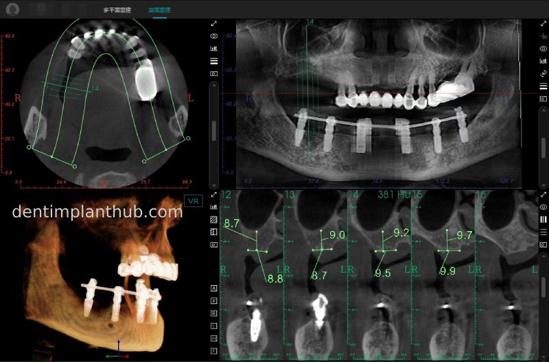 Case 3: Full mouth all-on-6 in a patient with severe periodontal disease