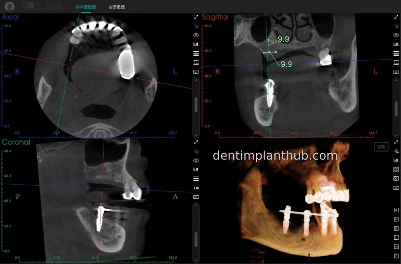 Case 3: Full mouth all-on-6 in a patient with severe periodontal disease