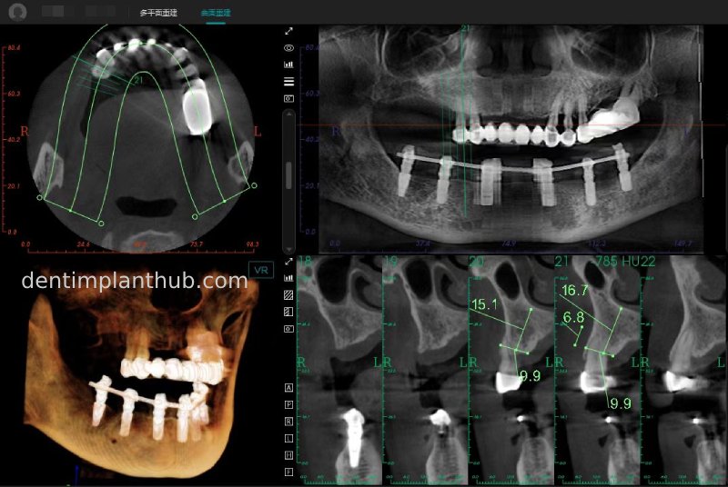 Case 3: Full mouth all-on-6 in a patient with severe periodontal disease