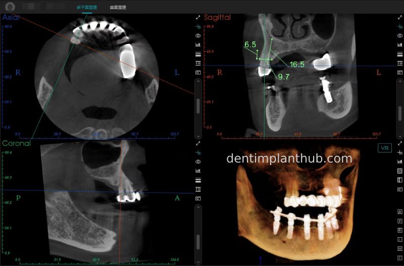 Case 3: Full mouth all-on-6 in a patient with severe periodontal disease