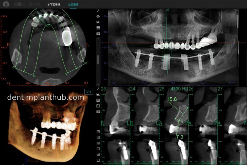Case 3: Full mouth all-on-6 in a patient with severe periodontal disease