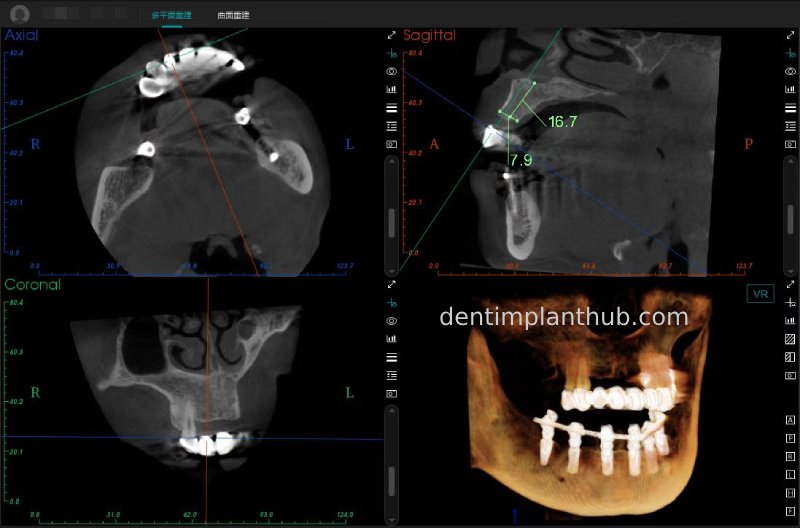 Case 3: Full mouth all-on-6 in a patient with severe periodontal disease
