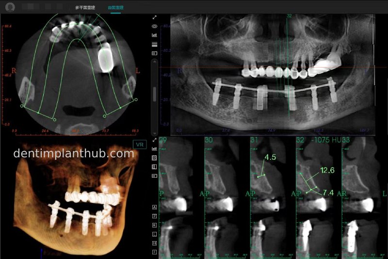 Case 3: Full mouth all-on-6 in a patient with severe periodontal disease