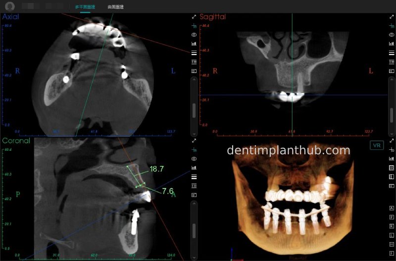Case 3: Full mouth all-on-6 in a patient with severe periodontal disease