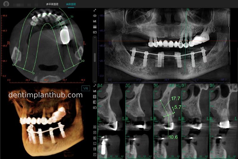 Case 3: Full mouth all-on-6 in a patient with severe periodontal disease