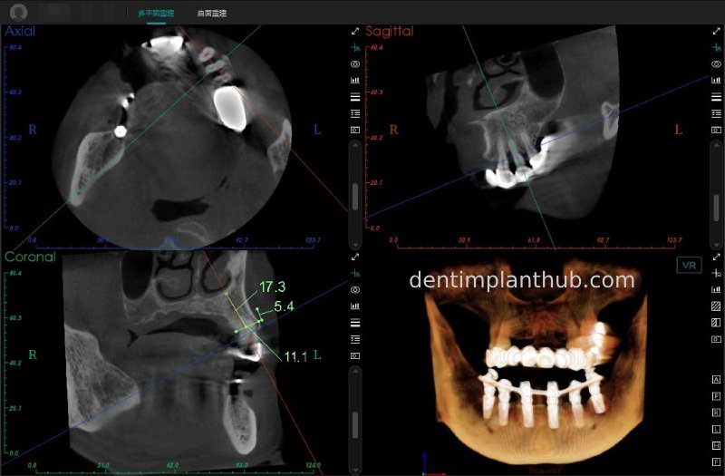 Case 3: Full mouth all-on-6 in a patient with severe periodontal disease