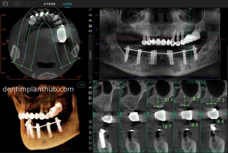 Case 3: Full mouth all-on-6 in a patient with severe periodontal disease