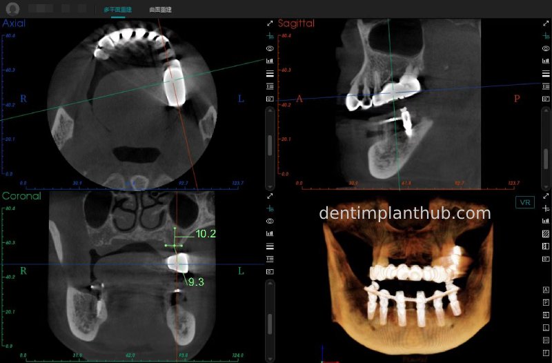 Case 3: Full mouth all-on-6 in a patient with severe periodontal disease