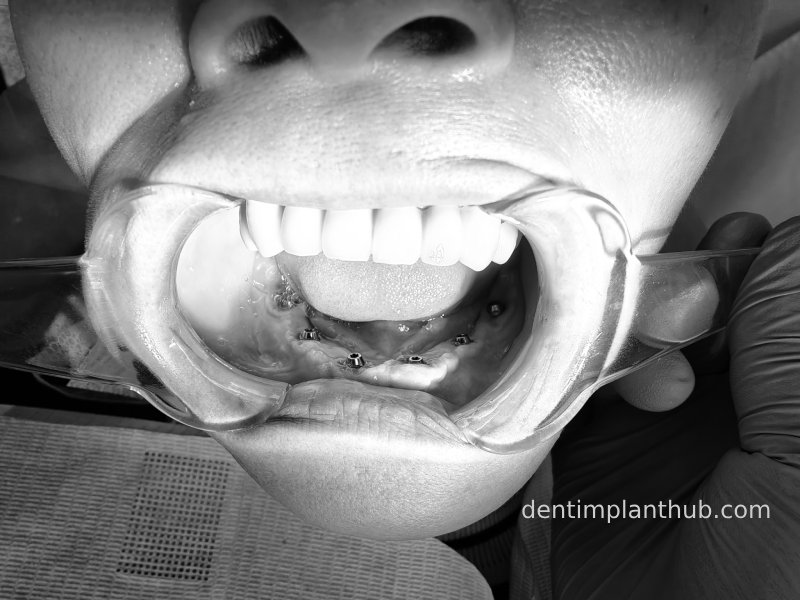 Case 3: Full mouth all-on-6 in a patient with severe periodontal disease