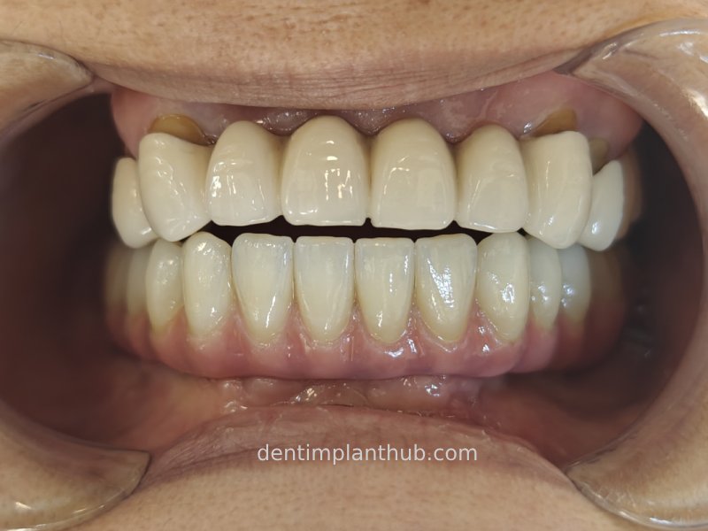 Case 3: Full mouth all-on-6 in a patient with severe periodontal disease
