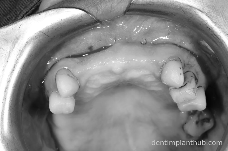 Case 3: Full mouth all-on-6 in a patient with severe periodontal disease