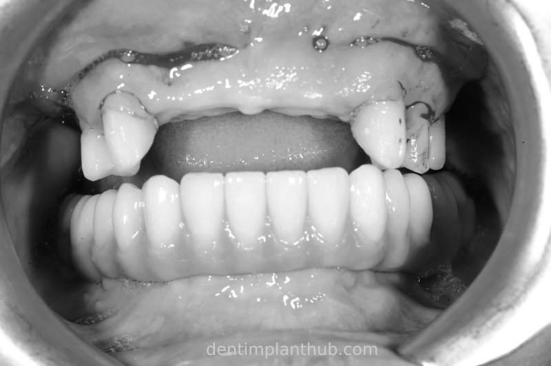 Case 3: Full mouth all-on-6 in a patient with severe periodontal disease