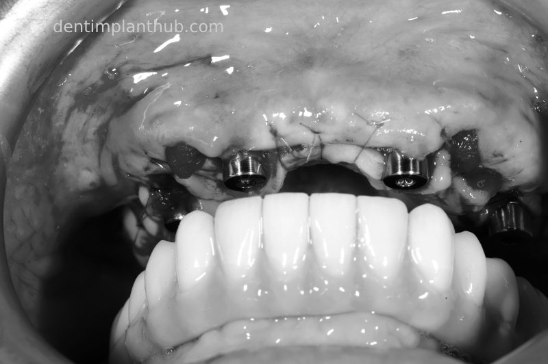 Case 3: Full mouth all-on-6 in a patient with severe periodontal disease