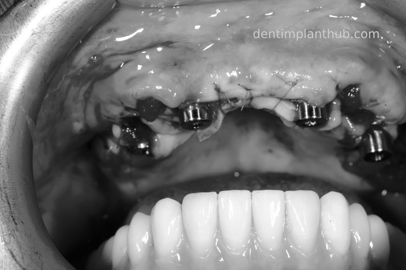 Case 3: Full mouth all-on-6 in a patient with severe periodontal disease