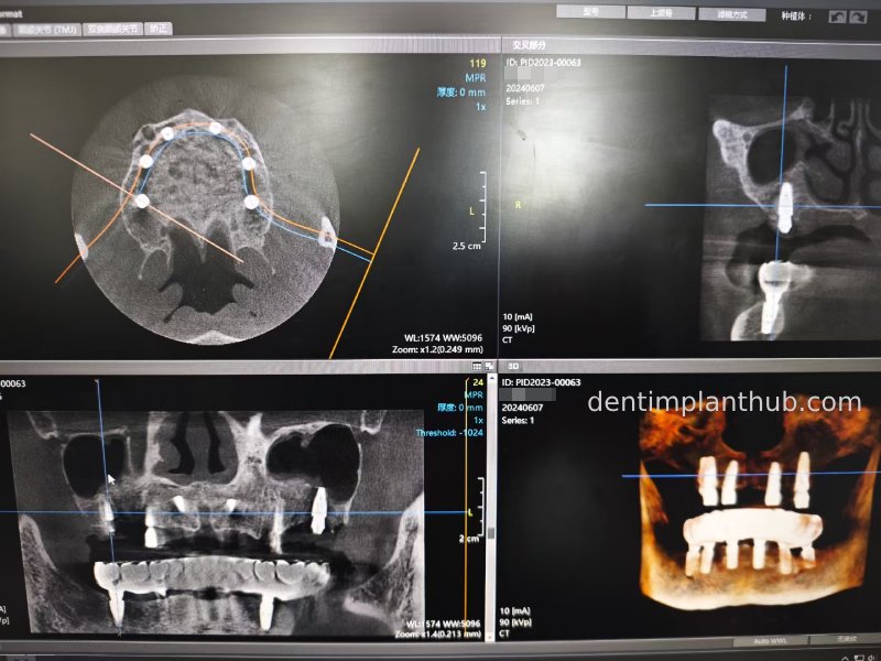 Case 3: Full mouth all-on-6 in a patient with severe periodontal disease