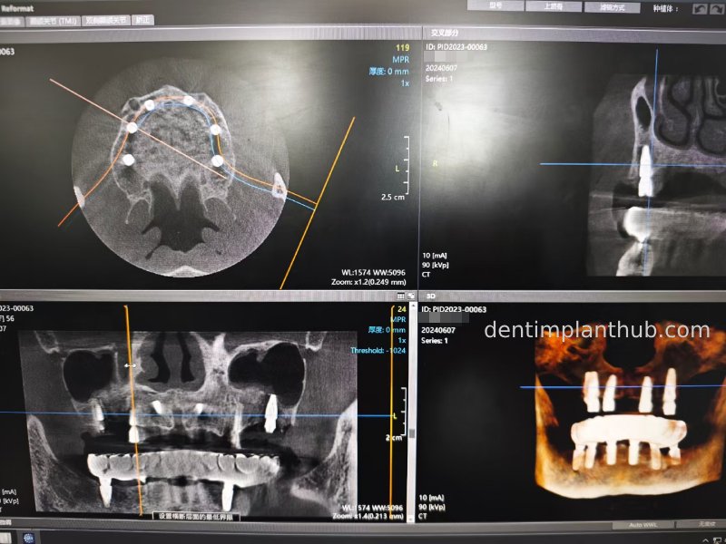 Case 3: Full mouth all-on-6 in a patient with severe periodontal disease