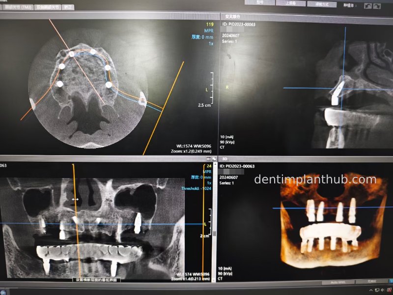 Case 3: Full mouth all-on-6 in a patient with severe periodontal disease
