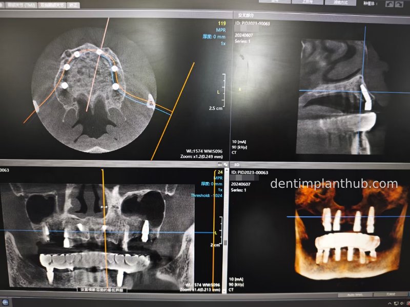 Case 3: Full mouth all-on-6 in a patient with severe periodontal disease