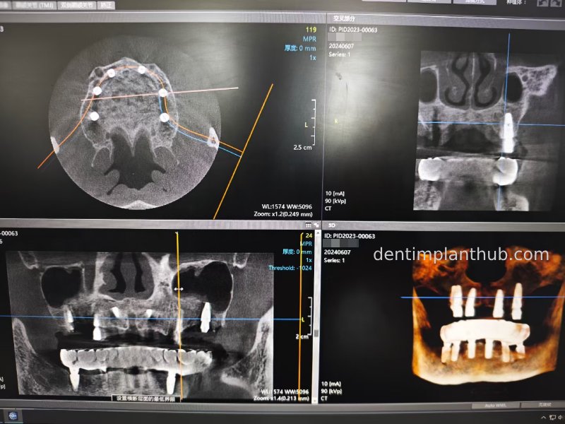 Case 3: Full mouth all-on-6 in a patient with severe periodontal disease