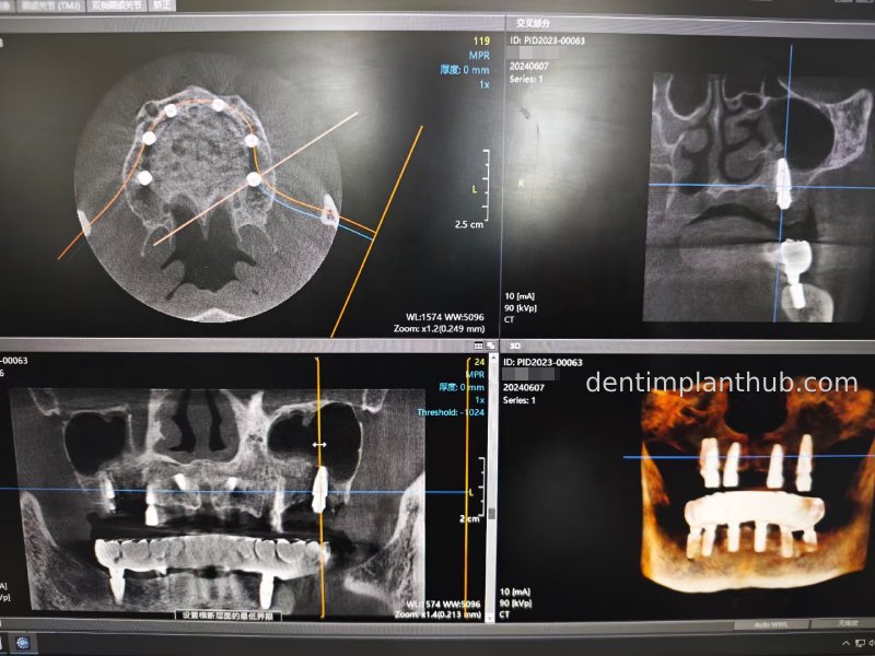 Case 3: Full mouth all-on-6 in a patient with severe periodontal disease