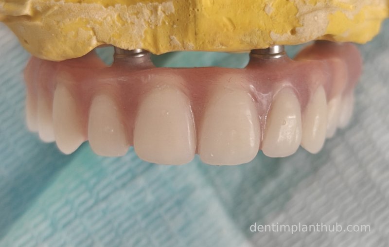 Case 3: Full mouth all-on-6 in a patient with severe periodontal disease