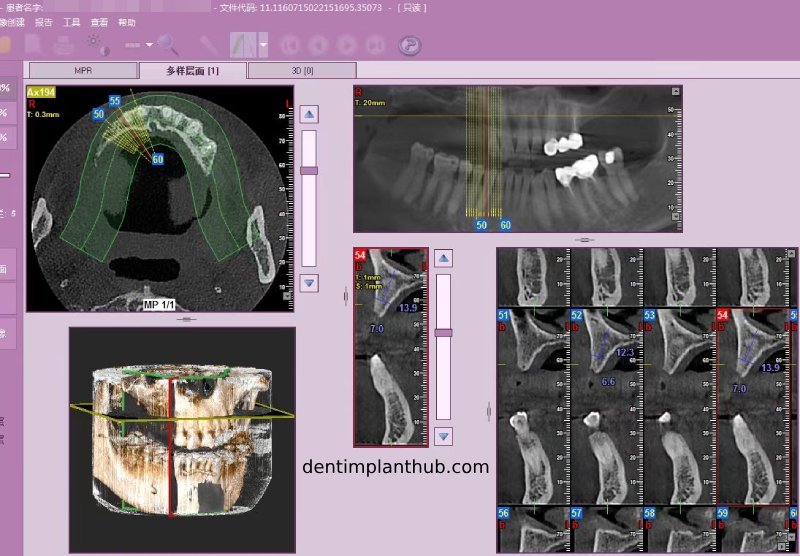 Case 4: Bilateral maxillary sinus lateral wall openings