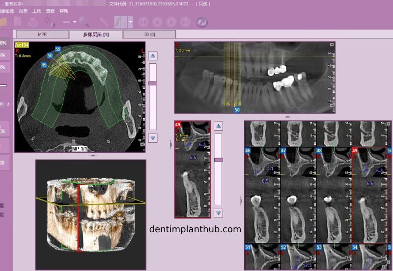 Case 4: Bilateral maxillary sinus lateral wall openings