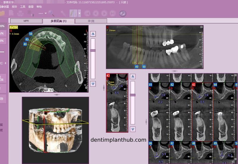 Case 4: Bilateral maxillary sinus lateral wall openings