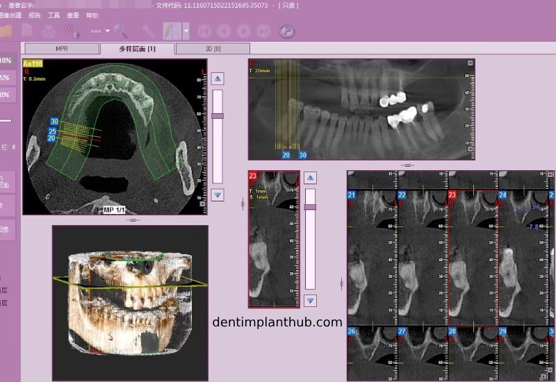 Case 4: Bilateral maxillary sinus lateral wall openings