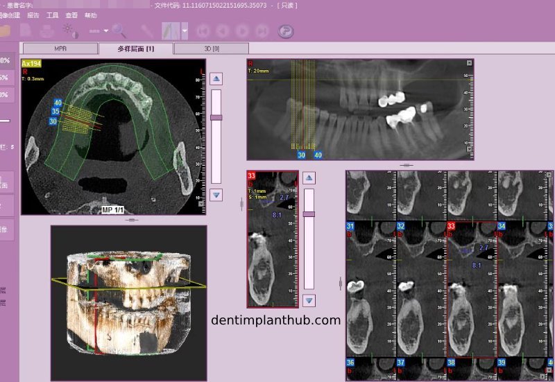Case 4: Bilateral maxillary sinus lateral wall openings