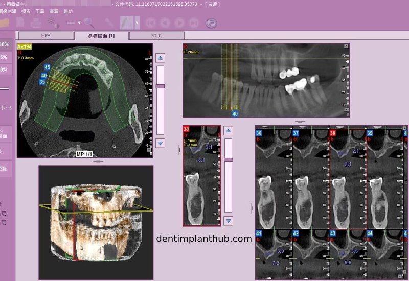 Case 4: Bilateral maxillary sinus lateral wall openings