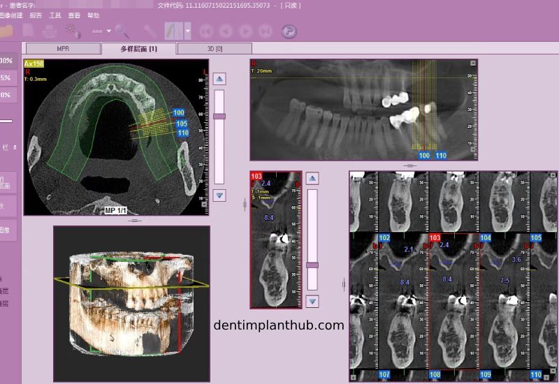 Case 4: Bilateral maxillary sinus lateral wall openings