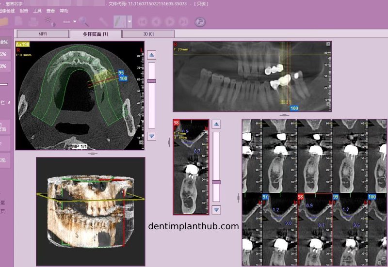 Case 4: Bilateral maxillary sinus lateral wall openings