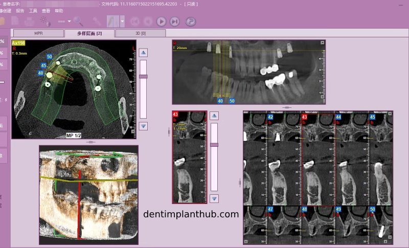 Case 4: Bilateral maxillary sinus lateral wall openings