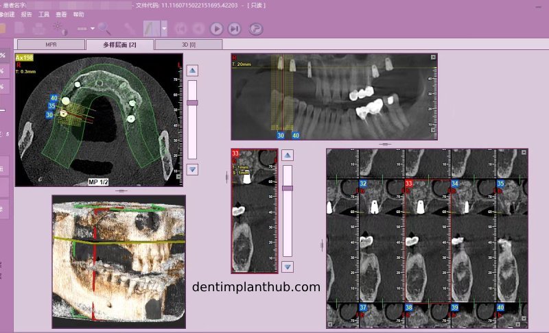 Case 4: Bilateral maxillary sinus lateral wall openings
