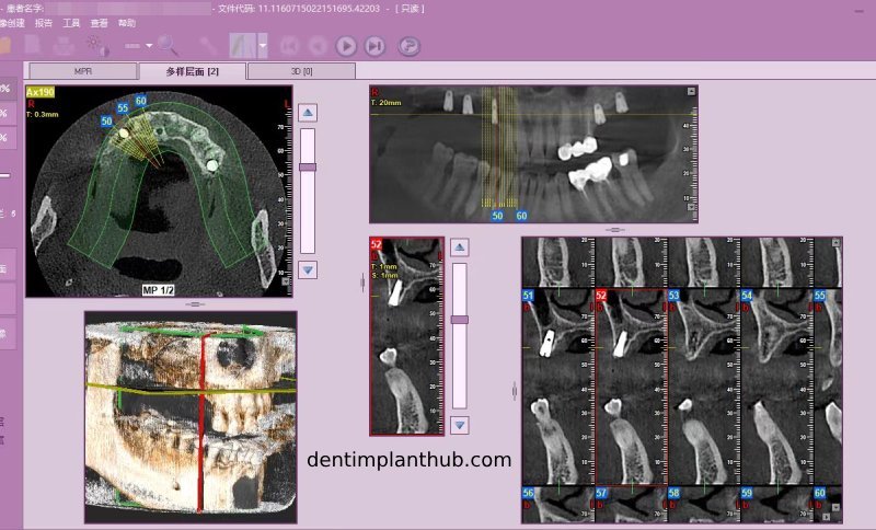 Case 4: Bilateral maxillary sinus lateral wall openings