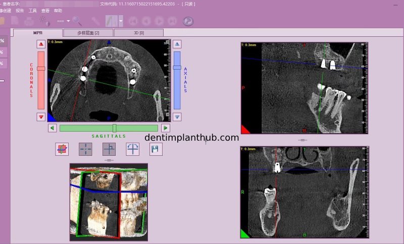 Case 4: Bilateral maxillary sinus lateral wall openings